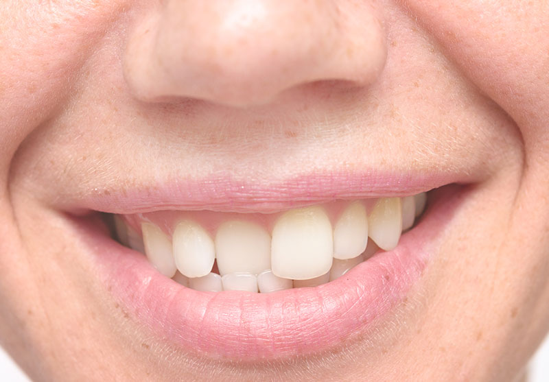 Crooked-and-Misaligned-Teeth