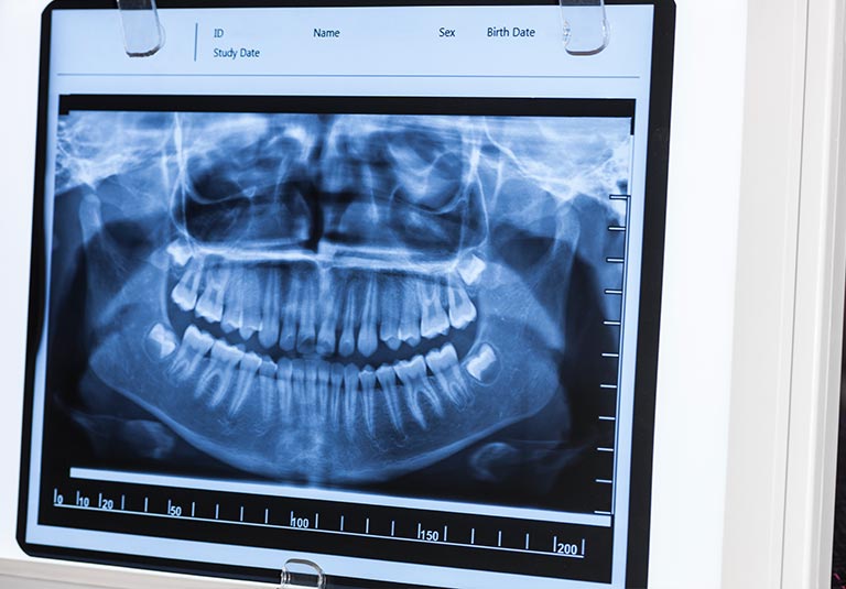 Dental-X-ray