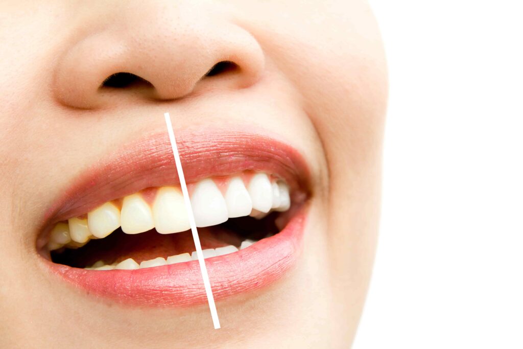 whitening spots on teeth