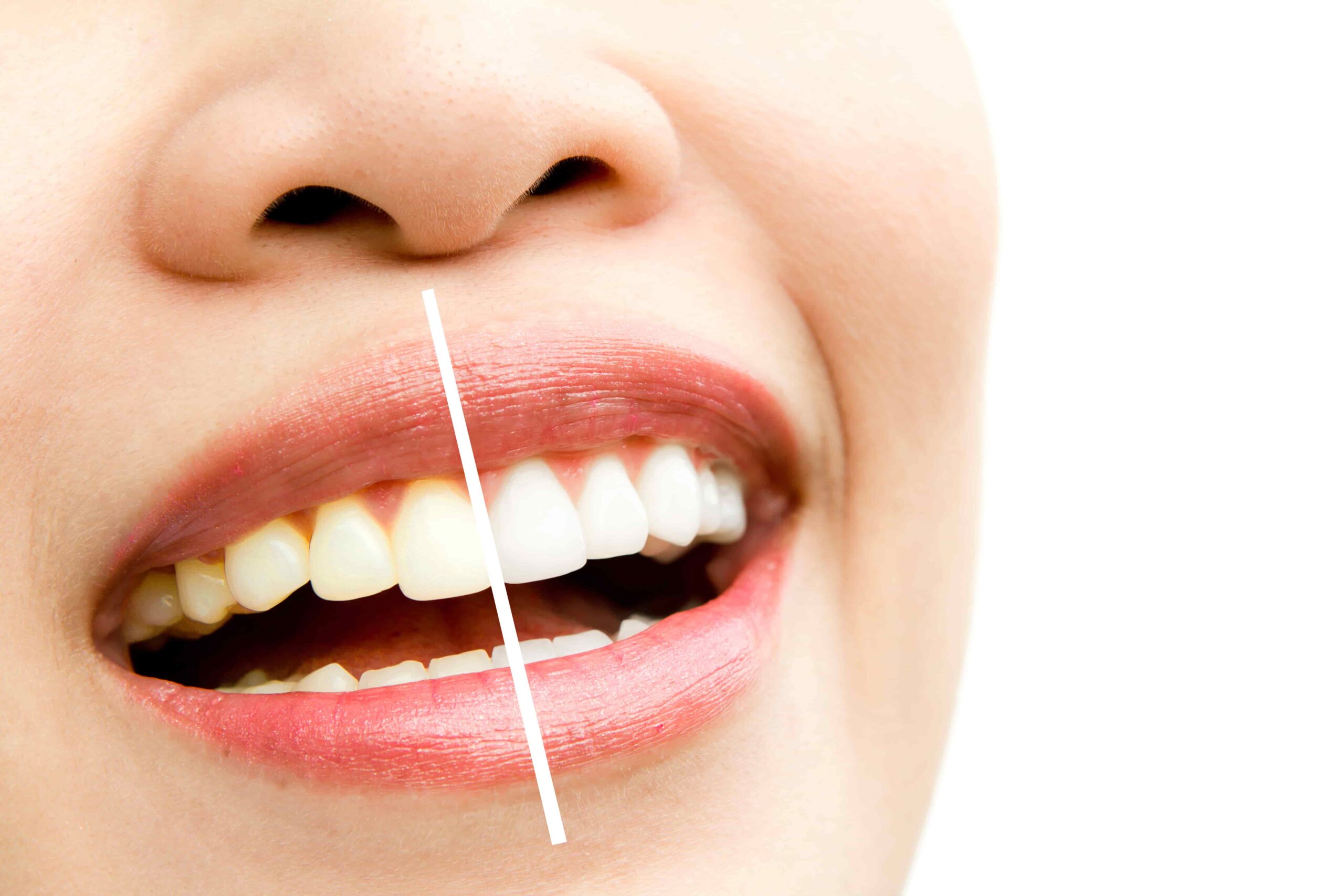 whitening spots on teeth
